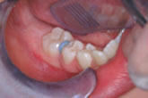 Orthodontics - Separator
