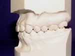 Orthodontics - Class I
