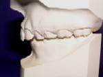 Orthodontics - Class II