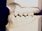 Orthodontics Class - III