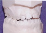 Orthodontics - Crossbite